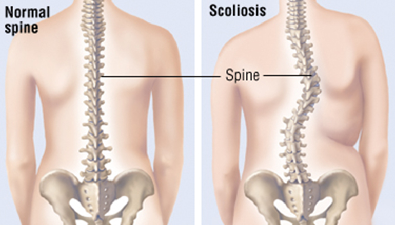 Scoliosis Exercises To Avoid: Which Are Bad For Scoliosis?